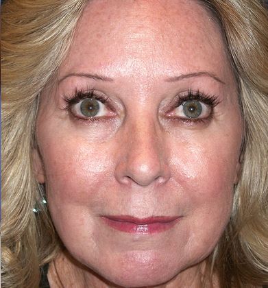 Botox® Cosmetic, Dysport, Xeomin Injectables Case 7 - After