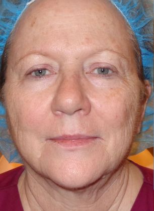 Obagi Blue Peel: Case 8 - Before Blue Peel