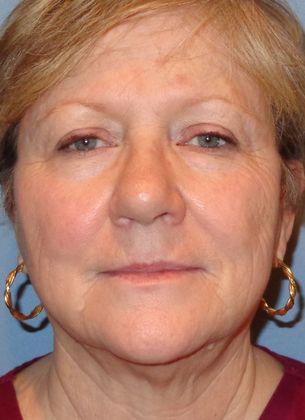 Obagi Blue Peel: Case 8 - After Blue Peel