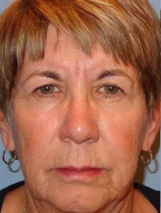 Obagi Blue Peel: Case 9 - Before Blue Peel