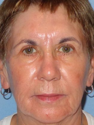 Obagi Blue Peel: Case 9 - After Blue Peel