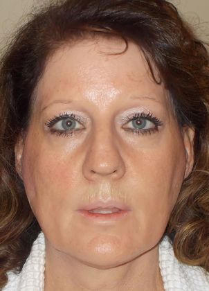 Soft Tissue Fillers: Case 12 - Before Fillers