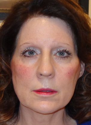 Soft Tissue Fillers: Case 12 - After Fillers