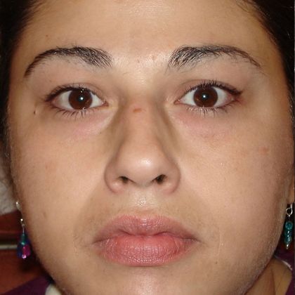 Permanent MakeUp Case 34 - Before