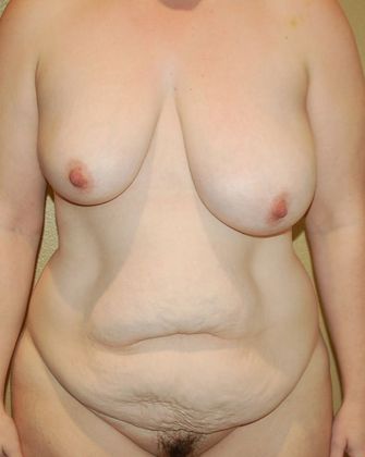 Mommy Makeover Case 76 - Before