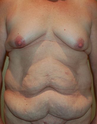 Massive Weight Loss : Case 36 - Before