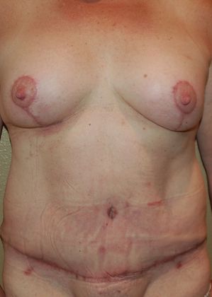 Massive Weight Loss : Case 36 - After