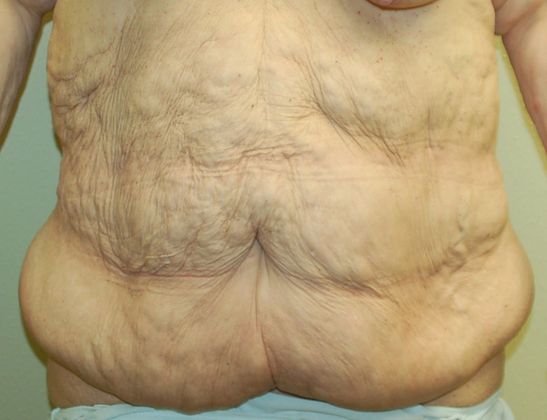 Massive Weight Loss : Case 37 - Before