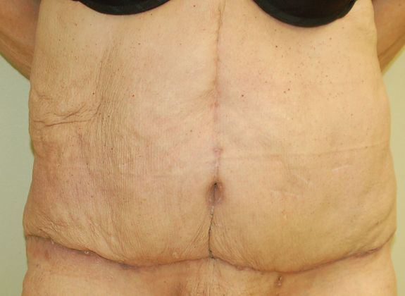 Massive Weight Loss : Case 37 - After