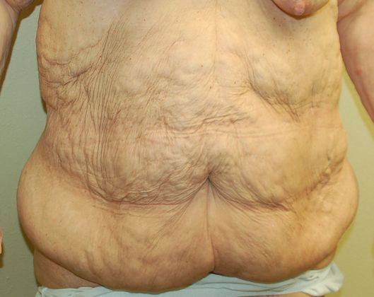 Massive Weight Loss : Case 37 - Before