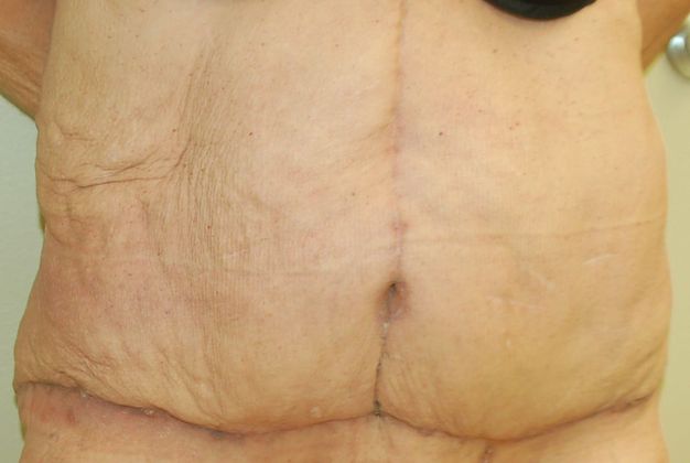 Massive Weight Loss : Case 37 - After