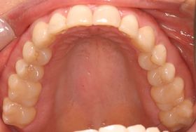 Teeth after treatment