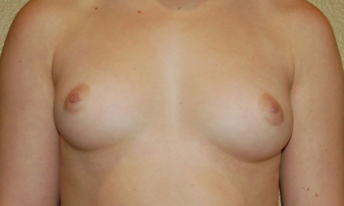 Breast Augmentation w/ Lift: Case 188 - Before