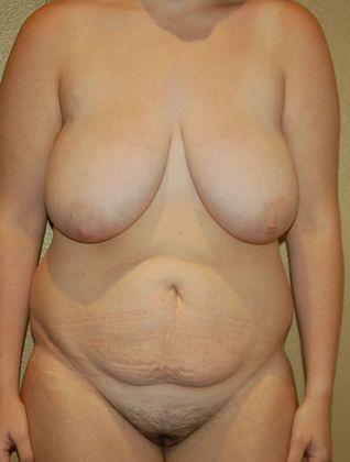 Massive Weight Loss : Case 38 - Before