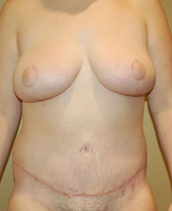 Massive Weight Loss : Case 38 - After