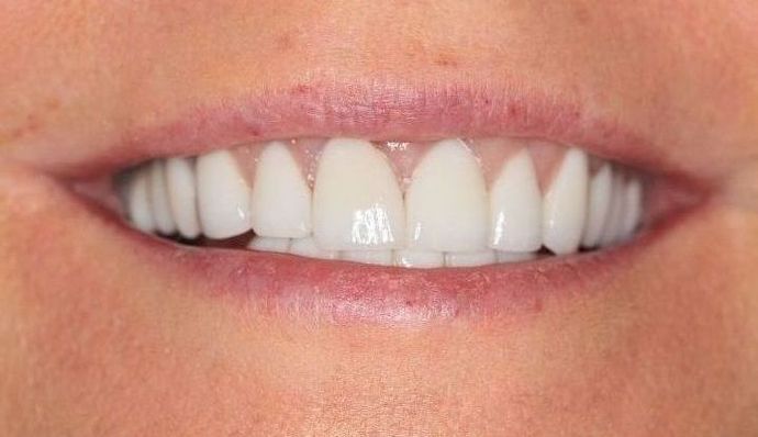 Full Mouth Reconstruction: Case 11 - after