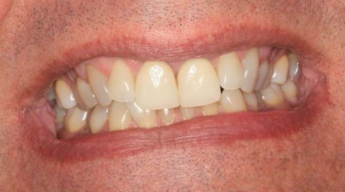 Invisalign Case 9 - Before