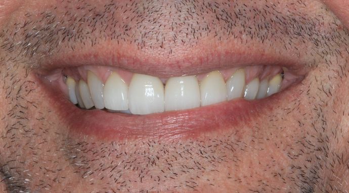 Invisalign Case 9 - After