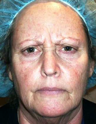 Soft Tissue Fillers Case 14 - Before