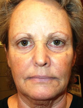 Soft Tissue Fillers Case 14 - After