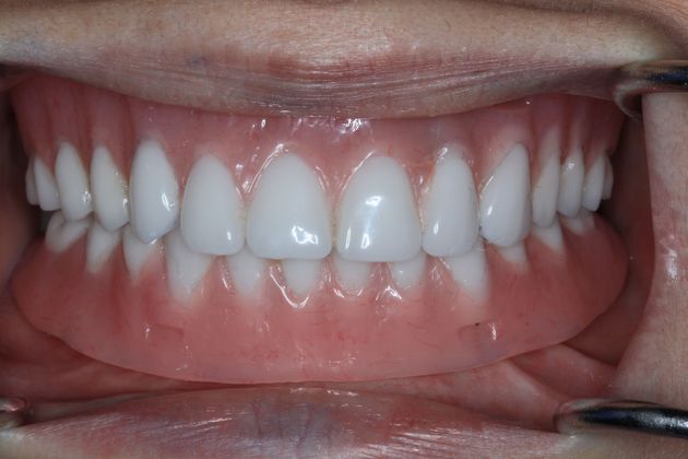 Implant Dentures Patient Photo - Scottsdale, AZ - Hybrid Implant ...