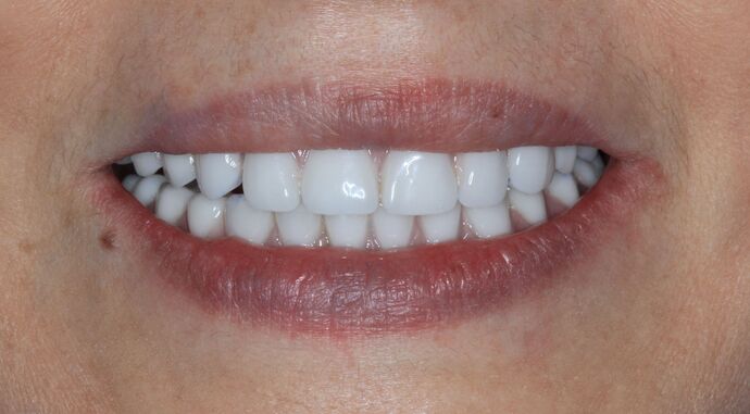 Hybrid Implant Dentures: Case 4 - After Implant Dentures