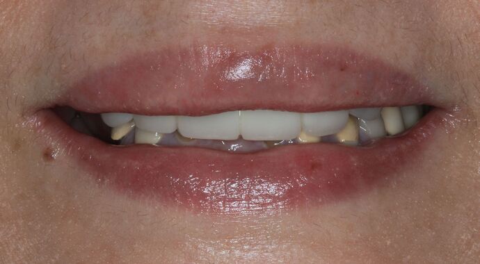 Hybrid Implant Dentures: Case 4 - Before Implant Dentures