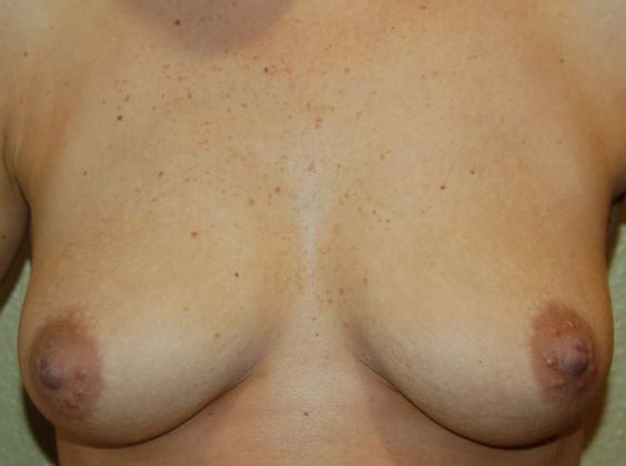 Breast Augmentation Case 403 - Before