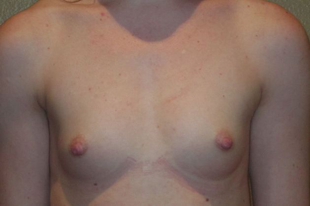 Breast Augmentation Case 407 - Before