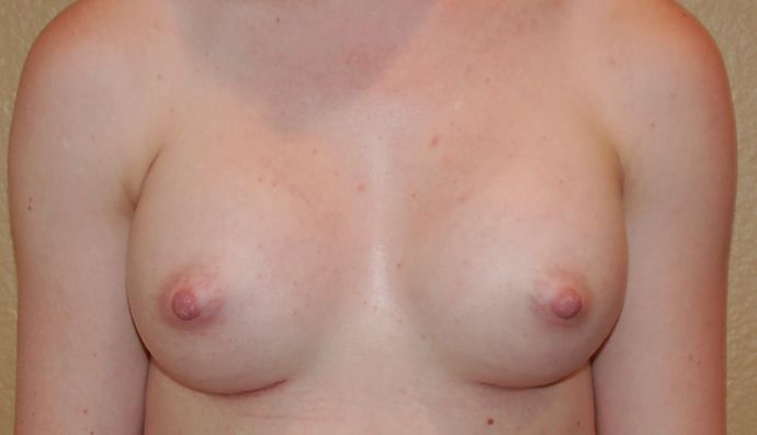 Breast Augmentation Case 407 - After