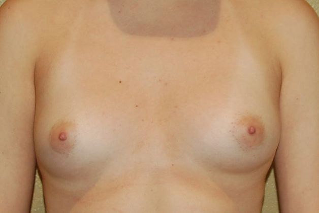 Breast Augmentation Case 411 - Before