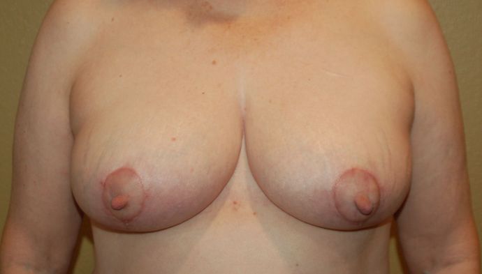 Breast Reduction Case 38 - After