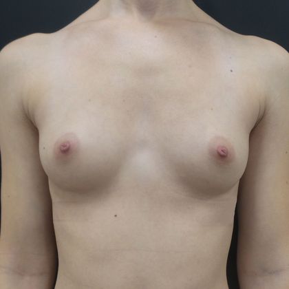 Breast Augmentation Case 4 - Before