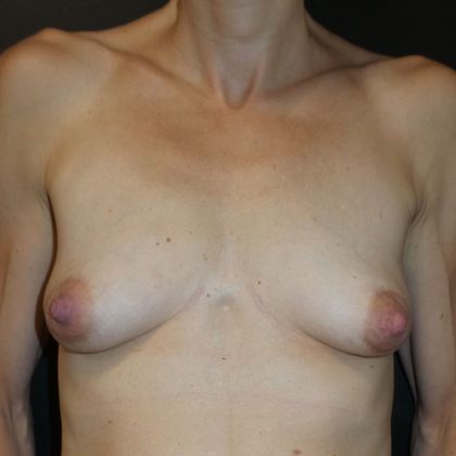 Breast Augmentation Case 14 - Before