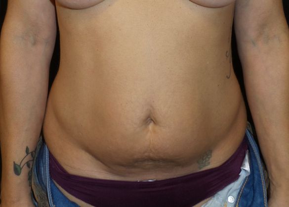 Tummy Tuck Case 22 - Before