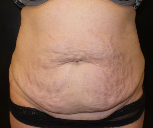 Tummy Tuck Case 27 - Before