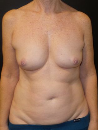 DIEP Flap Breast Reconstruction Case 23 - Before