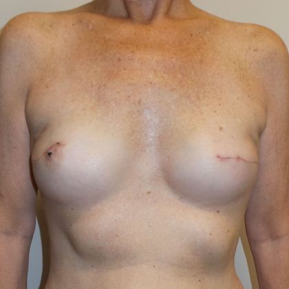 DIEP Flap Breast Reconstruction Case 28 - Before
