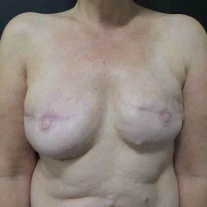 DIEP Flap Breast Reconstruction Case 29 - Before