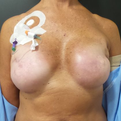 DIEP Flap Breast Reconstruction Case 30 - Before
