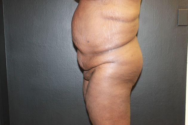 Brazilian Butt Lift: Case 3 - Before 