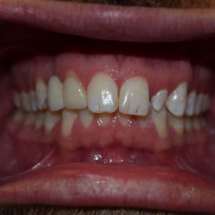 Smile Makeover 6 VENEERS (case 1) - Before