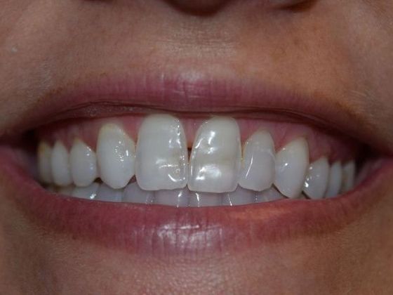 Smile Makeover 4 VENEERS (case 1) - Before