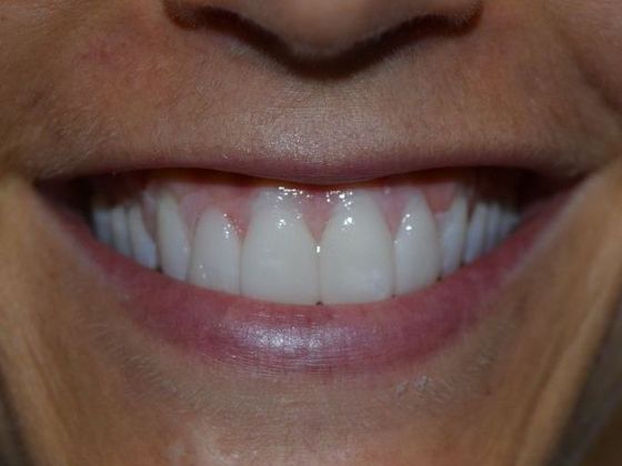 Smile Makeover 4 VENEERS (case 1) - After