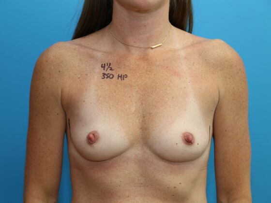 Breast Augmentation: Case 12 - Before