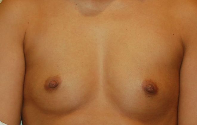 Breast Augmentation Case 414 - Before