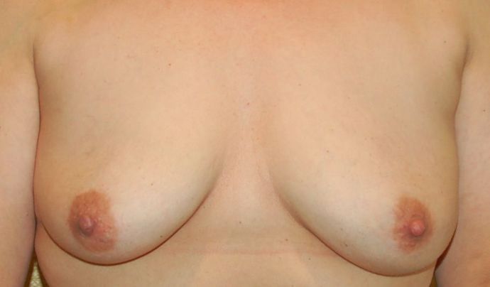 Breast Augmentation w/ Lift: Case 194 - Before
