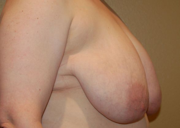 Breast Lift (Mastopexy): Case 49 - Before