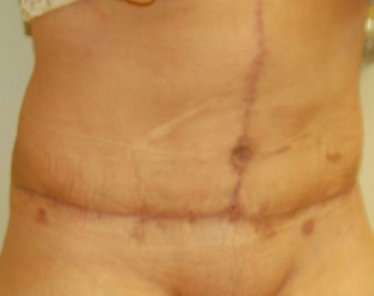 Tummy Tuck (Abdominoplasty): Case 115 - After