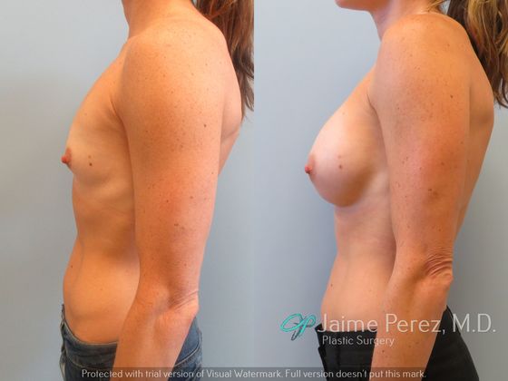 Breast Augmentation: 300 cc Silicone Breast Augmentation
